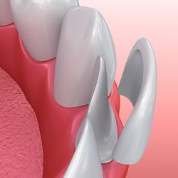 Digital image of custom veneers